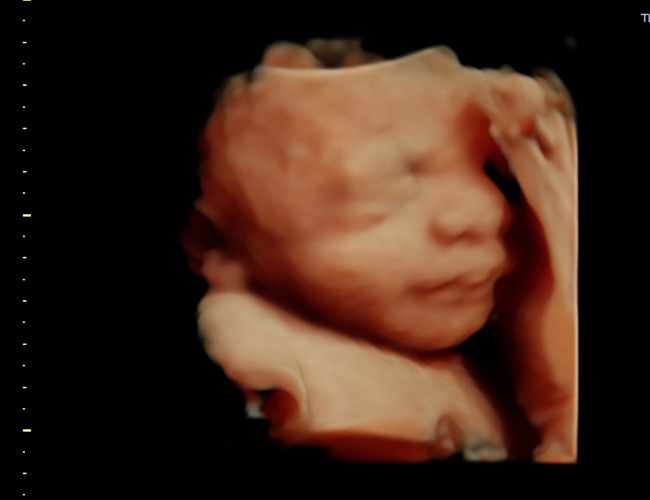 3D ultrasound image at 31 weeks